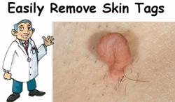 Recently Launched Website SkinTagsHelp.com Reveals Highly Effective Home Remedies for Skin Tag Removal